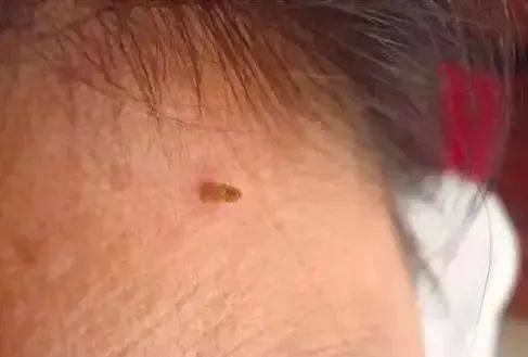 皇冠信用網在哪里开通
_脖子上长出的小肉粒皇冠信用網在哪里开通
，能揪吗？